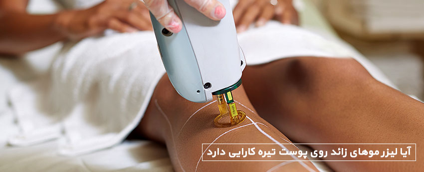 آیا لیزر موهای زائد روی پوست تیره کارایی دارد