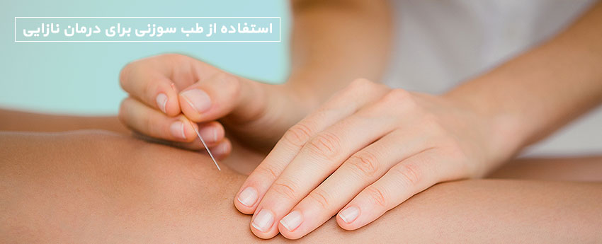 استفاده از طب سوزنی برای درمان نازایی