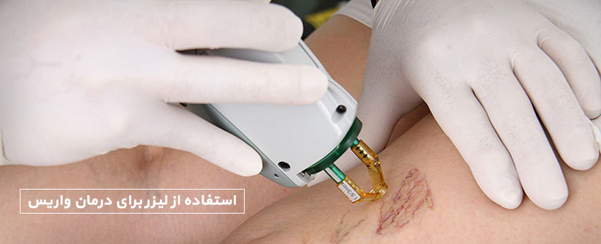 استفاده از لیزر برای درمان واریس