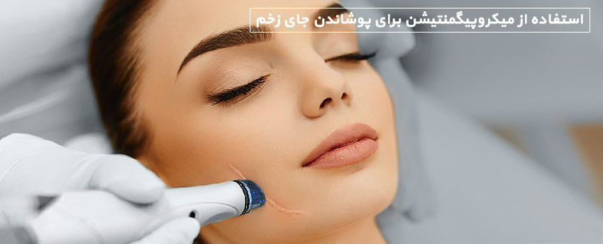 استفاده از میکروپیگمنتیشن برای پوشاندن جای زخم