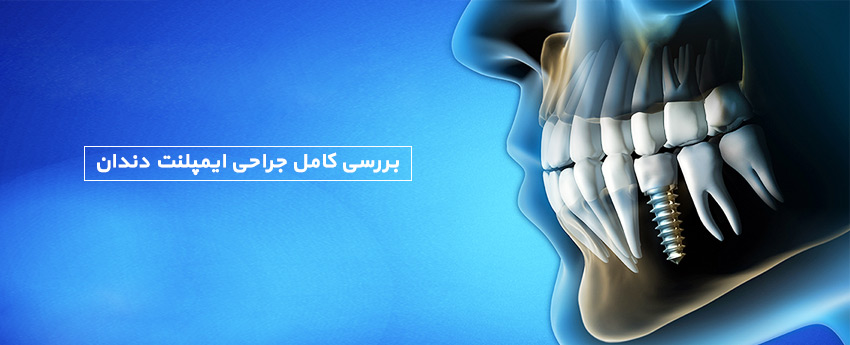 بررسی کامل جراحی ایمپلنت دندان