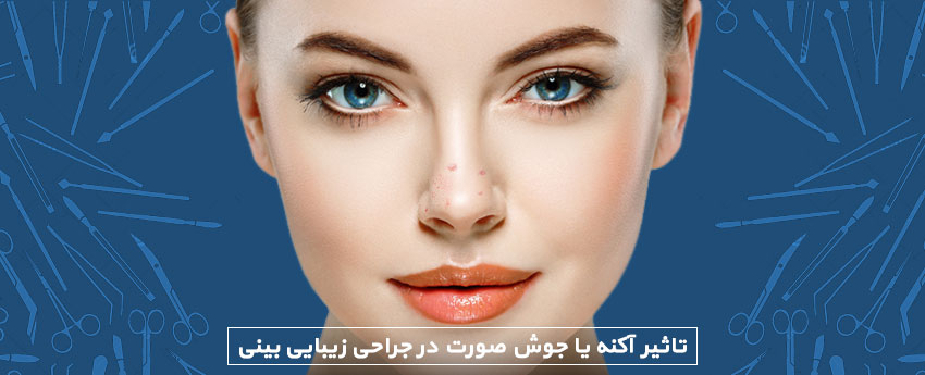 تاثیر آکنه یا جوش صورت در جراحی زیبایی بینی
