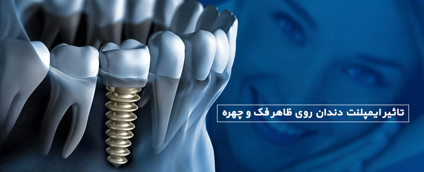 تاثیر ایمپلنت دندان روی ظاهر فک و چهره