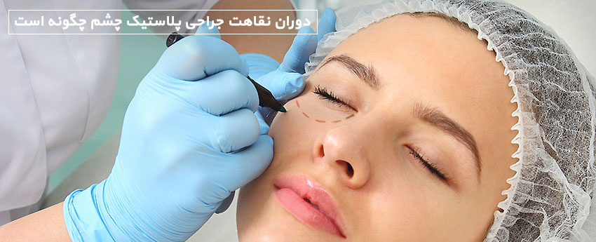 دوران نقاهت جراحی پلاستیک چشم چگونه است