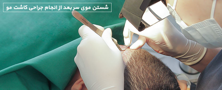 شستن موی سر بعد از انجام جراحی کاشت مو