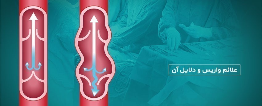 علائم واریس و دلایل آن