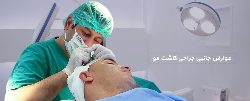 عوارض جانبی جراحی کاشت مو