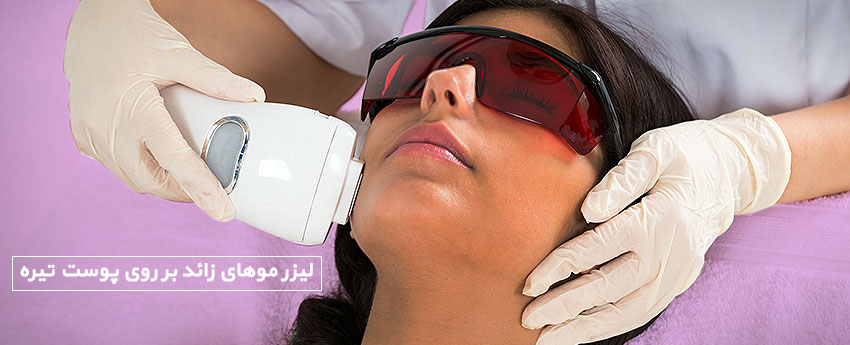 لیزر موهای زائد بر روی پوست تیره