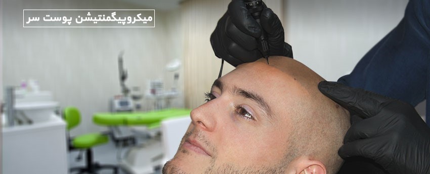 میکروپیگمنتیشن پوست سر