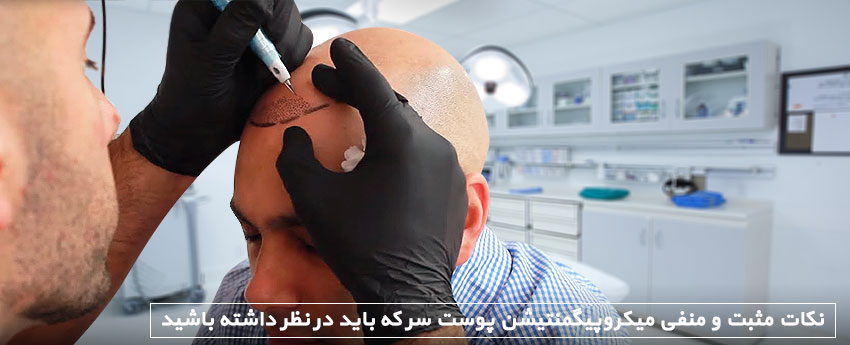 نکات مثبت و منفی میکروپیگمنتیشن پوست سر که باید در نظر داشته باشید