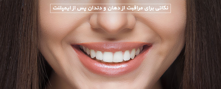 نکاتی برای مراقبت از دهان و دندان پس از ایمپلنت