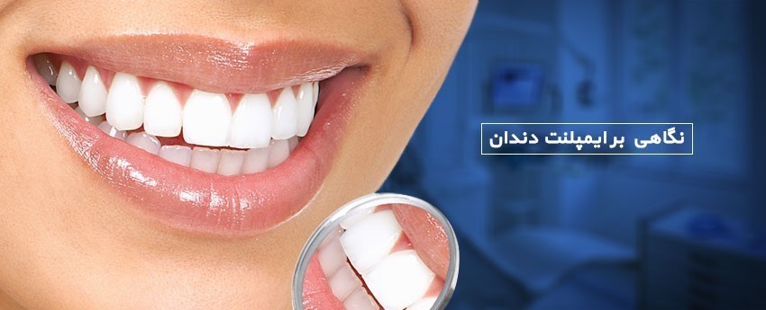 نگاهی بر ایمپلنت دندان