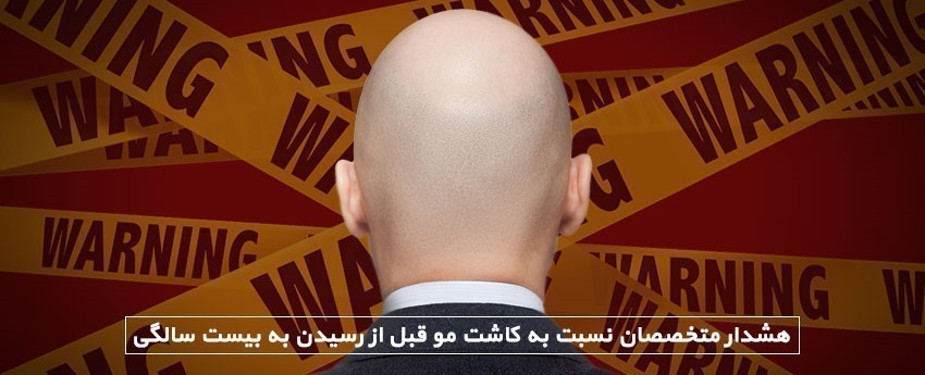 هشدار متخصصان نسبت به کاشت مو قبل از رسیدن به بیست سالگی