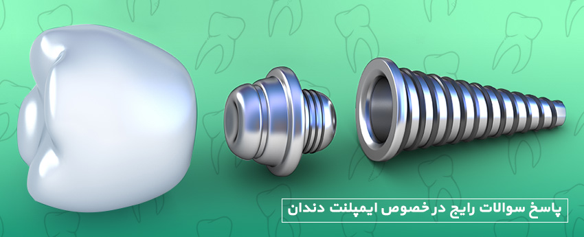 پاسخ سوالات رایج در خصوص ایمپلنت دندان