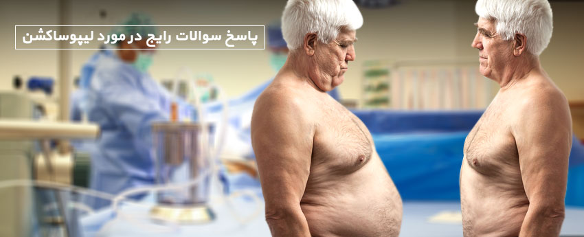 پاسخ سوالات رایج در مورد لیپوساکشن