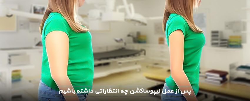 پس از عمل لیپوساکشن چه انتظاراتی داشته باشیم