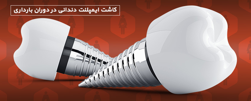 کاشت ایمپلنت دندانی در دوران بارداری